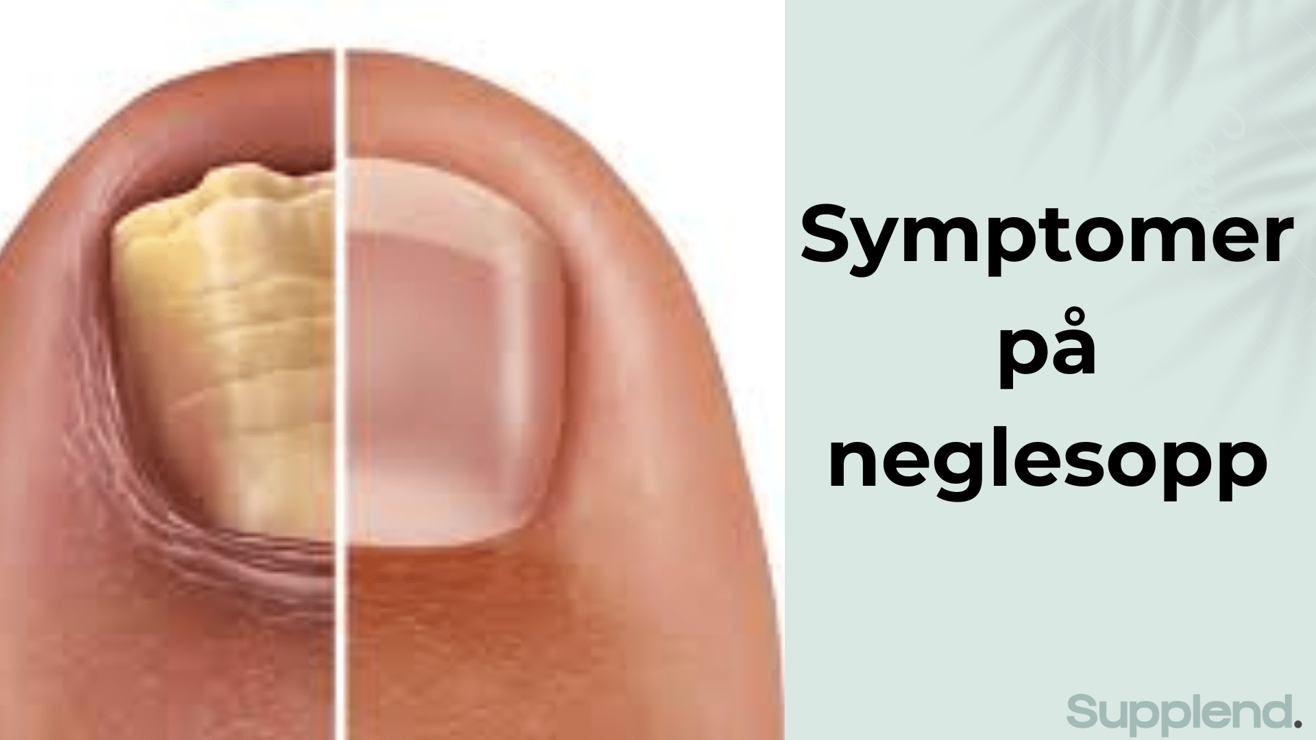 Symptomer Og Behandling Av Neglesopp Supplend NO symptomer-og-behandling-av-neglesopp-supplend-no